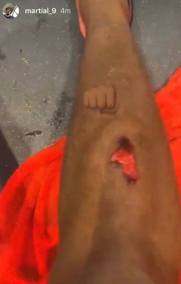 L'infortunio sui social dopo il derby della città di Manchester L'infortunio sui social dopo il derby della città di Manchester