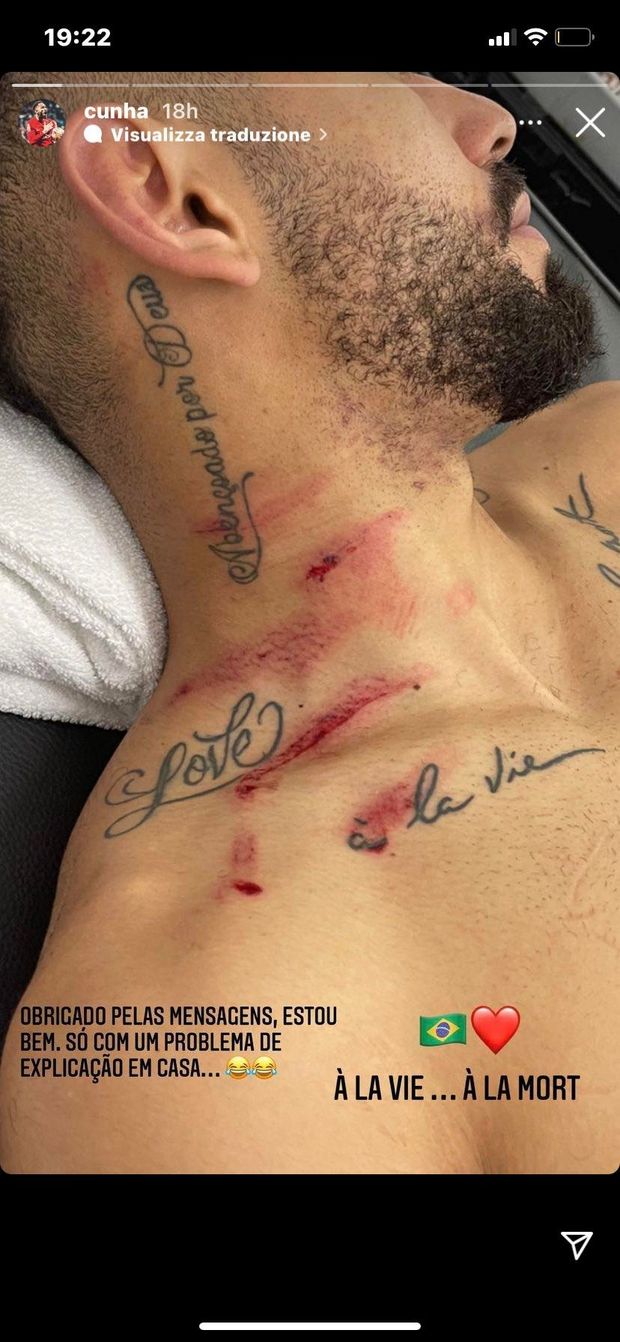 FOTO Intervento killer in Ecuador-Brasile: Matheus Cunha mostra i segni sui social- immagine 3