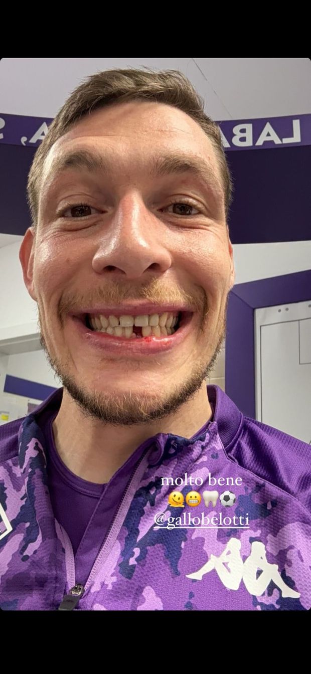 Belotti il gladiatore viola in campo. In uno scontro ha perso un dente- immagine 2