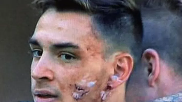 Il profondo taglio in faccia di Mattia De Sciglio durante Verona - Milan, foto calcioweb.eu