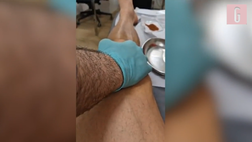 VIDEO Ibrahimovic shock: Zlatan mostra come “svuotava” il ginocchio ogni settimana