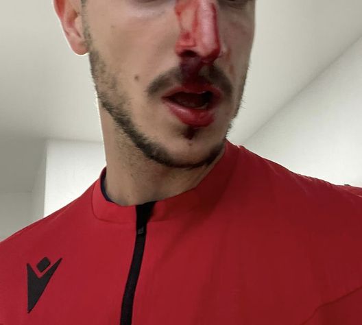 Derby giovanile in Catalogna: testata all’arbitro e naso rotto- immagine 2