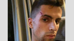 FOTO Cancelo, notte da incubo: l’ex Inter e Juventus rapinato e ferito in casa