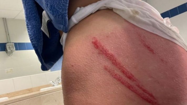 Le conseguenze sul gluteo di Juanjo Nieto per l'entrataccia dell'avversario espulso dopo 12 secondi 