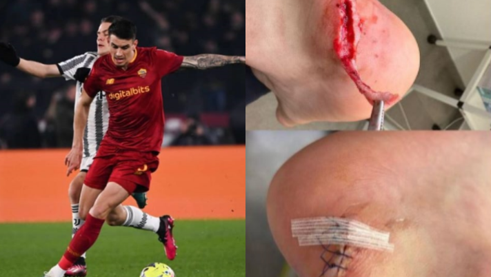 Roma, Ibanez mostra i segni del fallo di Fagioli: sei punti di sutura al piede - immagine 1