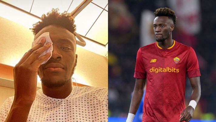 Roma, infortunio Abraham: ferita alla palpebra inferiore e punti di sutura - immagine 1